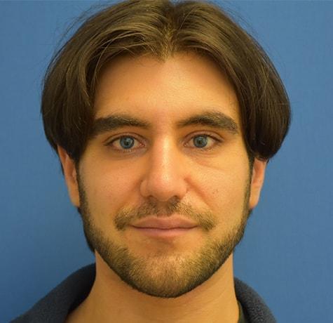 Chin Implant after at Neal Goldberg, MD in Scarsdale, NY