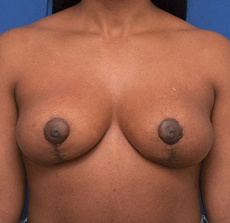 Breast Lift after at Neal Goldberg, MD in Scarsdale, NY