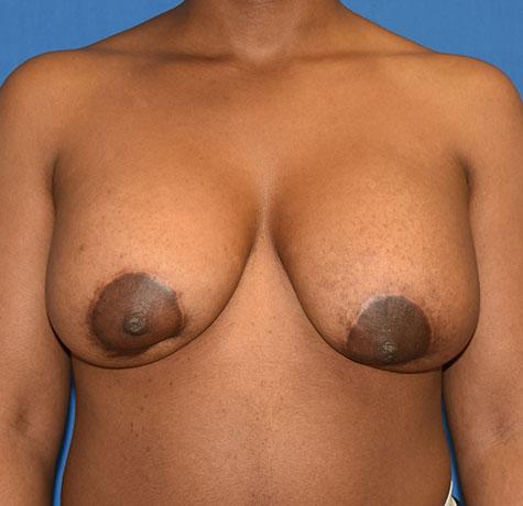 Breast Lift before at Neal Goldberg, MD in Scarsdale, NY