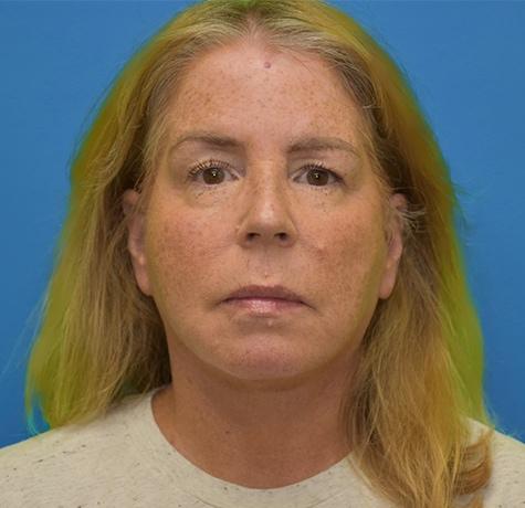 Neck Lift after at Neal Goldberg, MD in Scarsdale, NY