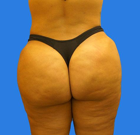 Neal Goldberg, MD bbl after — Scarsdale, NY