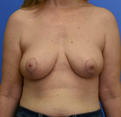 Breast Lift after at Neal Goldberg, MD in Scarsdale, NY