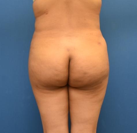 Brazilian Butt Lift after at Neal Goldberg, MD in Scarsdale, NY