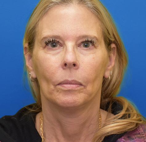 Neck Lift after at Neal Goldberg, MD in Scarsdale, NY