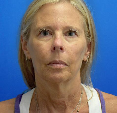 Neck Lift before at Neal Goldberg, MD in Scarsdale, NY