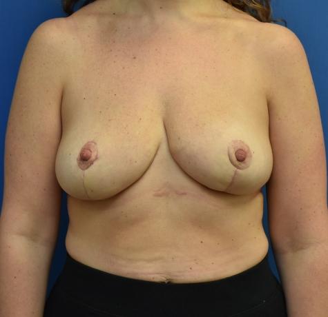 Breast Reduction after at Neal Goldberg, MD in Scarsdale, NY