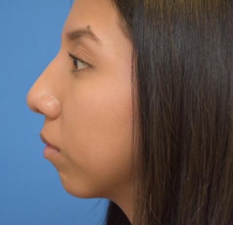 Functional Rhinoplasty after at Neal Goldberg, MD in Scarsdale, NY