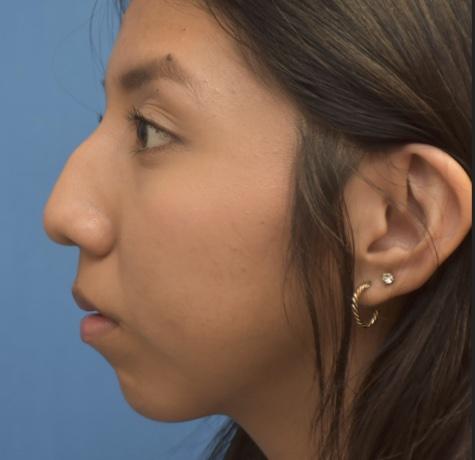 Functional Rhinoplasty before at Neal Goldberg, MD in Scarsdale, NY