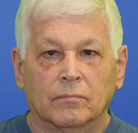 Neal Goldberg, MD blepharoplasty after — Scarsdale, NY