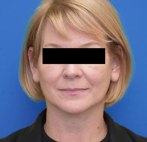 Facelift after at Neal Goldberg, MD in Scarsdale, NY