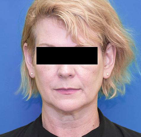 Facelift before at Neal Goldberg, MD in Scarsdale, NY
