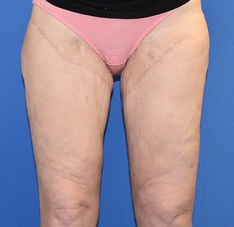 Thigh Lift after at Neal Goldberg, MD in Scarsdale, NY