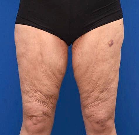 Thigh Lift before at Neal Goldberg, MD in Scarsdale, NY