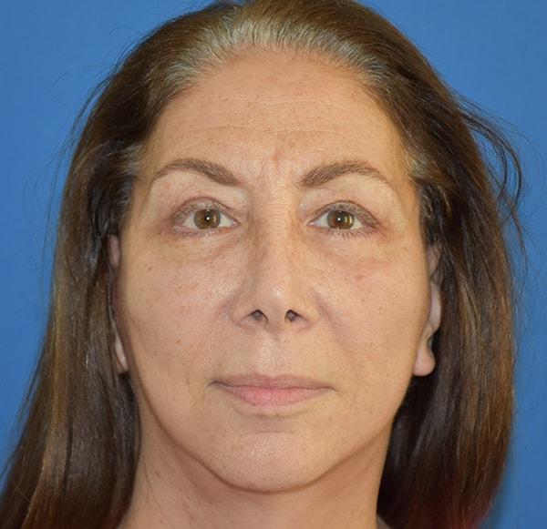 Neal Goldberg, MD facelift after — Scarsdale, NY