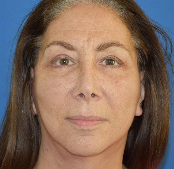 Fat Transfer after at Neal Goldberg, MD in Scarsdale, NY