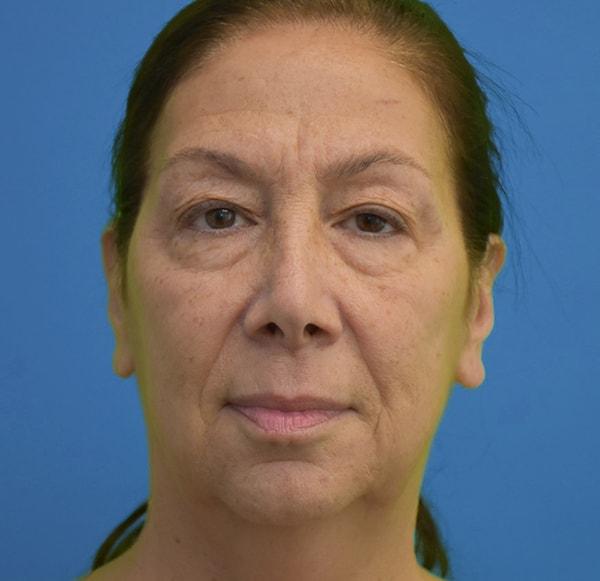 Fat Transfer before at Neal Goldberg, MD in Scarsdale, NY