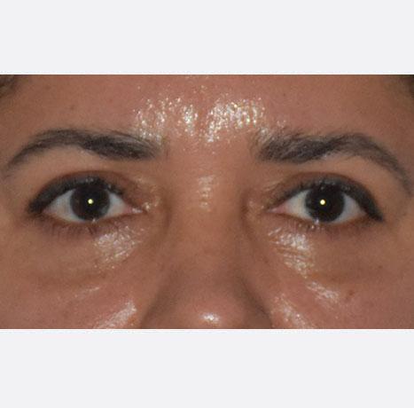 Neal Goldberg, MD blepharoplasty after — Scarsdale, NY