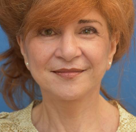 Facelift after at Neal Goldberg, MD in Scarsdale, NY