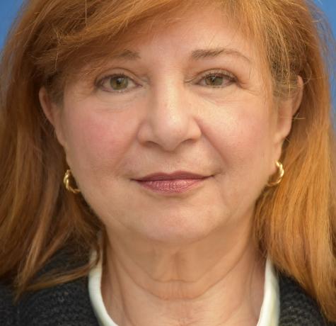 Facelift before at Neal Goldberg, MD in Scarsdale, NY