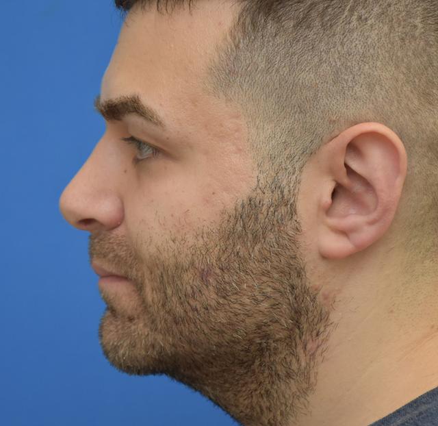 Rhinoplasty after at Neal Goldberg, MD in Scarsdale, NY