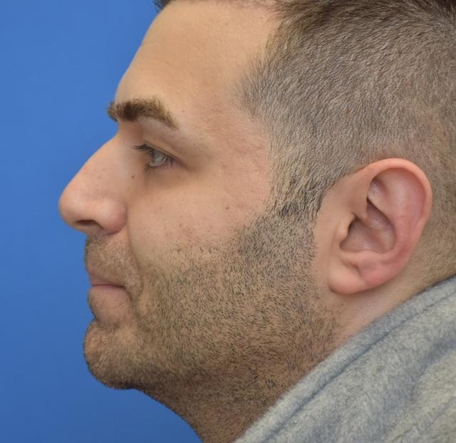 Rhinoplasty before at Neal Goldberg, MD in Scarsdale, NY