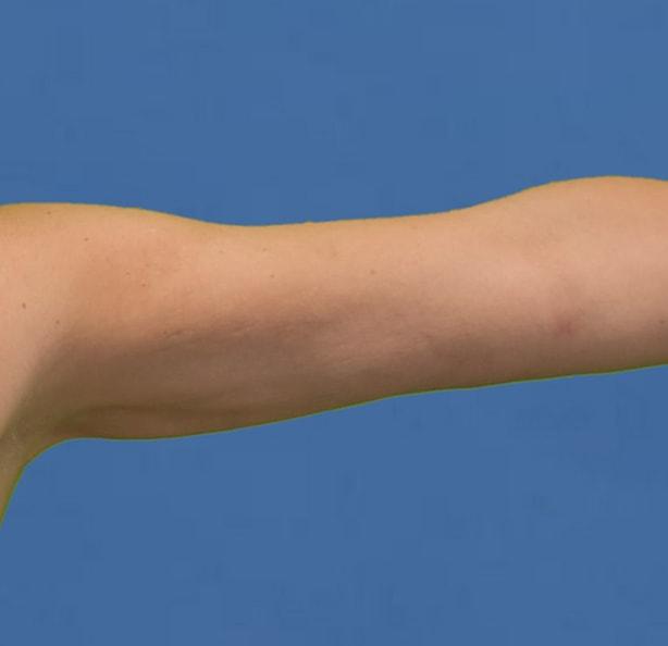Liposuction after at Neal Goldberg, MD in Scarsdale, NY