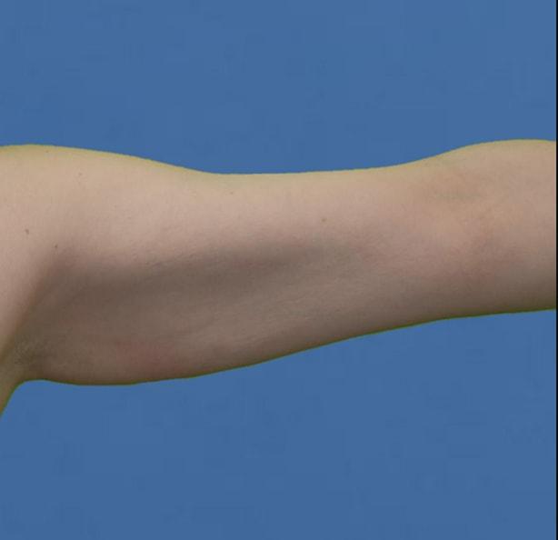 Liposuction before at Neal Goldberg, MD in Scarsdale, NY