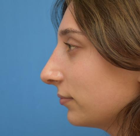 Functional Rhinoplasty after at Neal Goldberg, MD in Scarsdale, NY