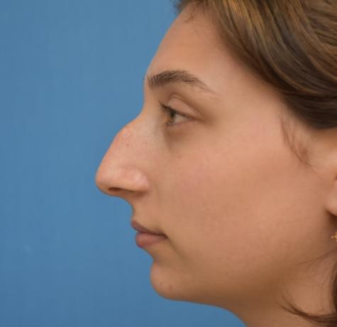 Functional Rhinoplasty before at Neal Goldberg, MD in Scarsdale, NY