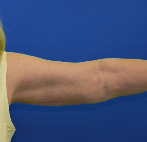 Neal Goldberg, MD liposuction after — Scarsdale, NY
