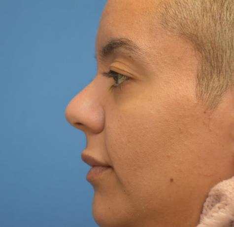 Functional Rhinoplasty after at Neal Goldberg, MD in Scarsdale, NY