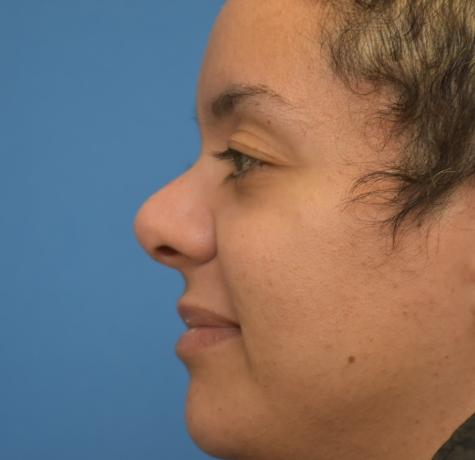 Functional Rhinoplasty before at Neal Goldberg, MD in Scarsdale, NY