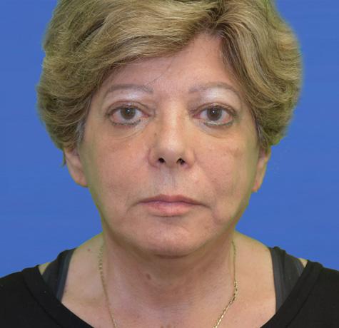 Neal Goldberg, MD facelift after — Scarsdale, NY