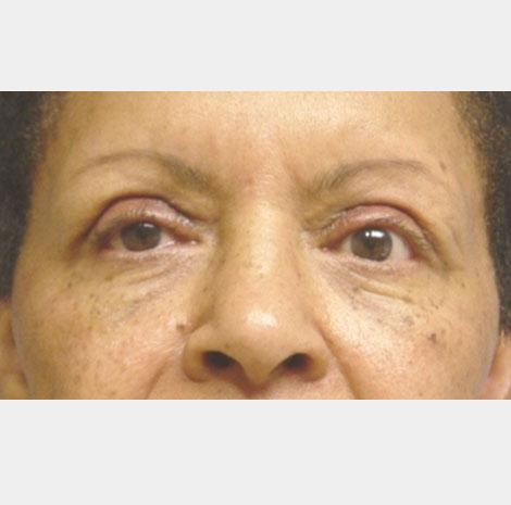 Brow Lift after at Neal Goldberg, MD in Scarsdale, NY