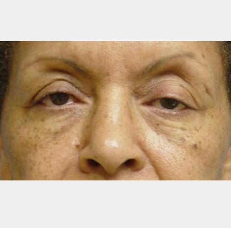 Brow Lift before at Neal Goldberg, MD in Scarsdale, NY