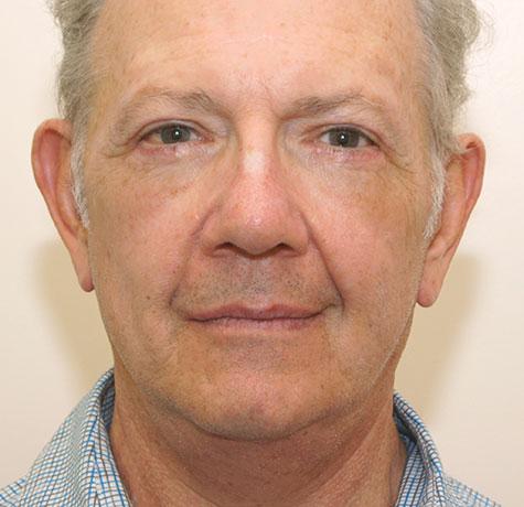 Facelift after at Neal Goldberg, MD in Scarsdale, NY