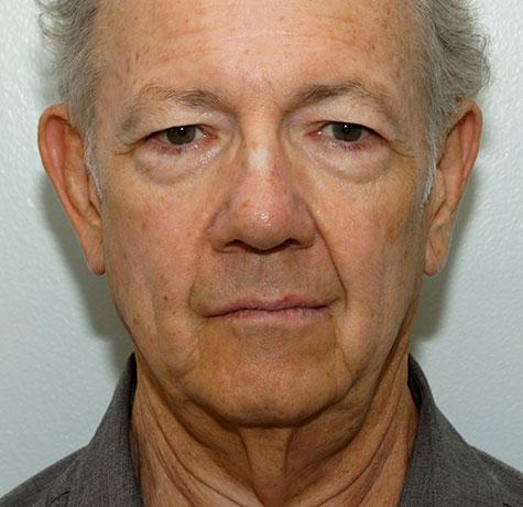 Facelift before at Neal Goldberg, MD in Scarsdale, NY