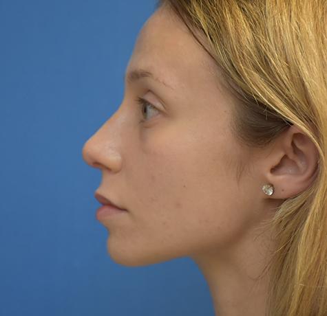 Neal Goldberg, MD rhinoplasty after — Scarsdale, NY