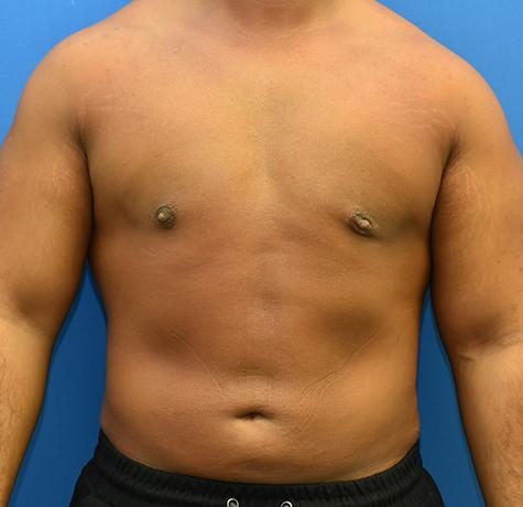 Liposuction after at Neal Goldberg, MD in Scarsdale, NY