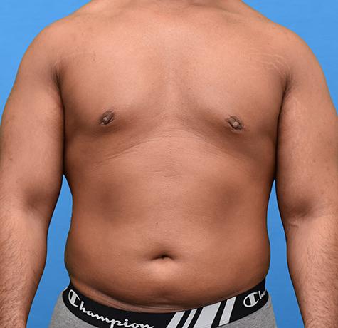 Liposuction before at Neal Goldberg, MD in Scarsdale, NY