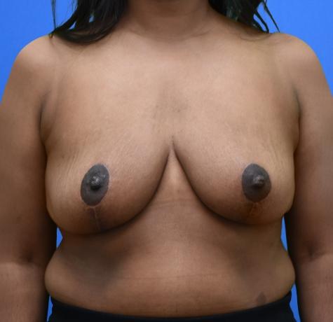 Breast Reduction after at Neal Goldberg, MD in Scarsdale, NY