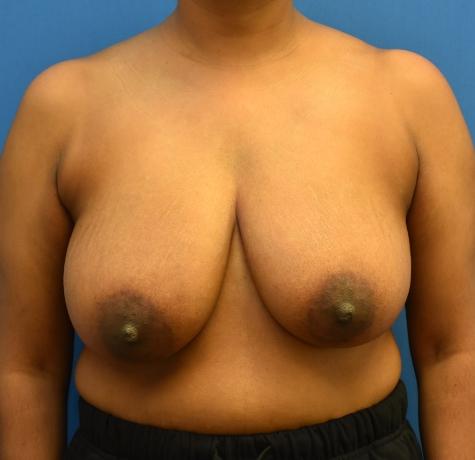 Breast Reduction before at Neal Goldberg, MD in Scarsdale, NY