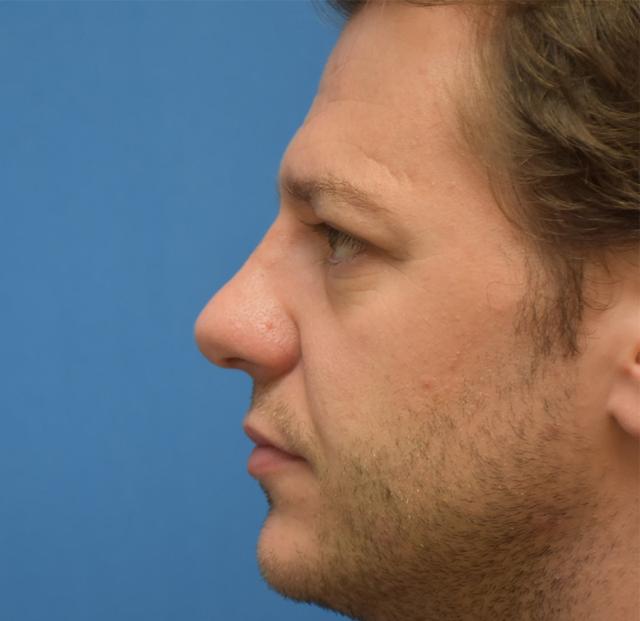 Functional Rhinoplasty after at Neal Goldberg, MD in Scarsdale, NY