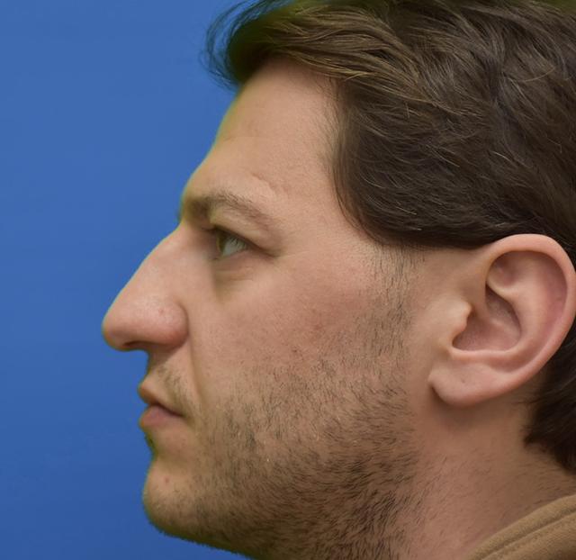 Functional Rhinoplasty before at Neal Goldberg, MD in Scarsdale, NY