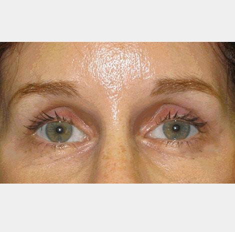 Brow Lift after at Neal Goldberg, MD in Scarsdale, NY