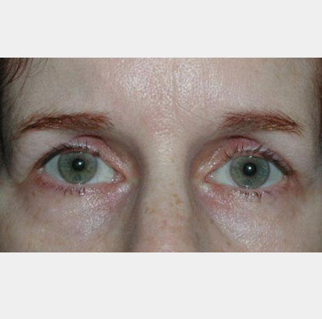 Brow Lift before at Neal Goldberg, MD in Scarsdale, NY