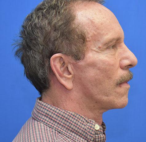 Neck Lift after at Neal Goldberg, MD in Scarsdale, NY