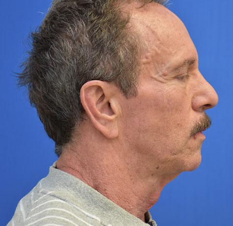 Neck Lift before at Neal Goldberg, MD in Scarsdale, NY
