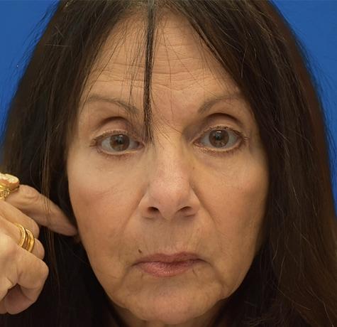 Neal Goldberg, MD blepharoplasty after — Scarsdale, NY