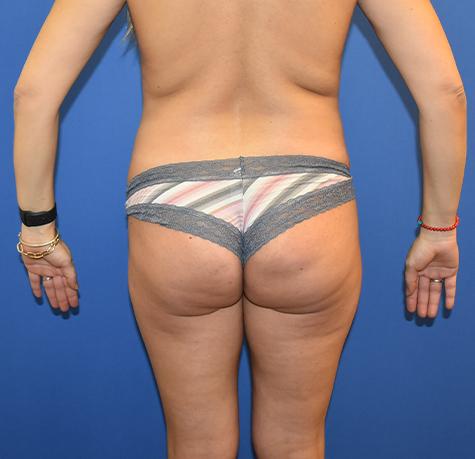 Liquid BBL before at Neal Goldberg, MD in Scarsdale, NY